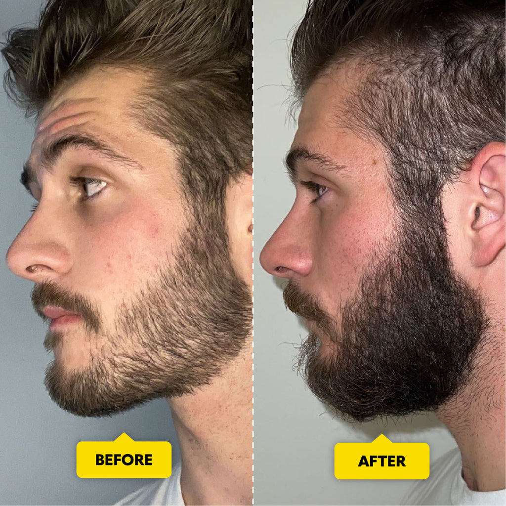 Beard & Hair Derma Roller